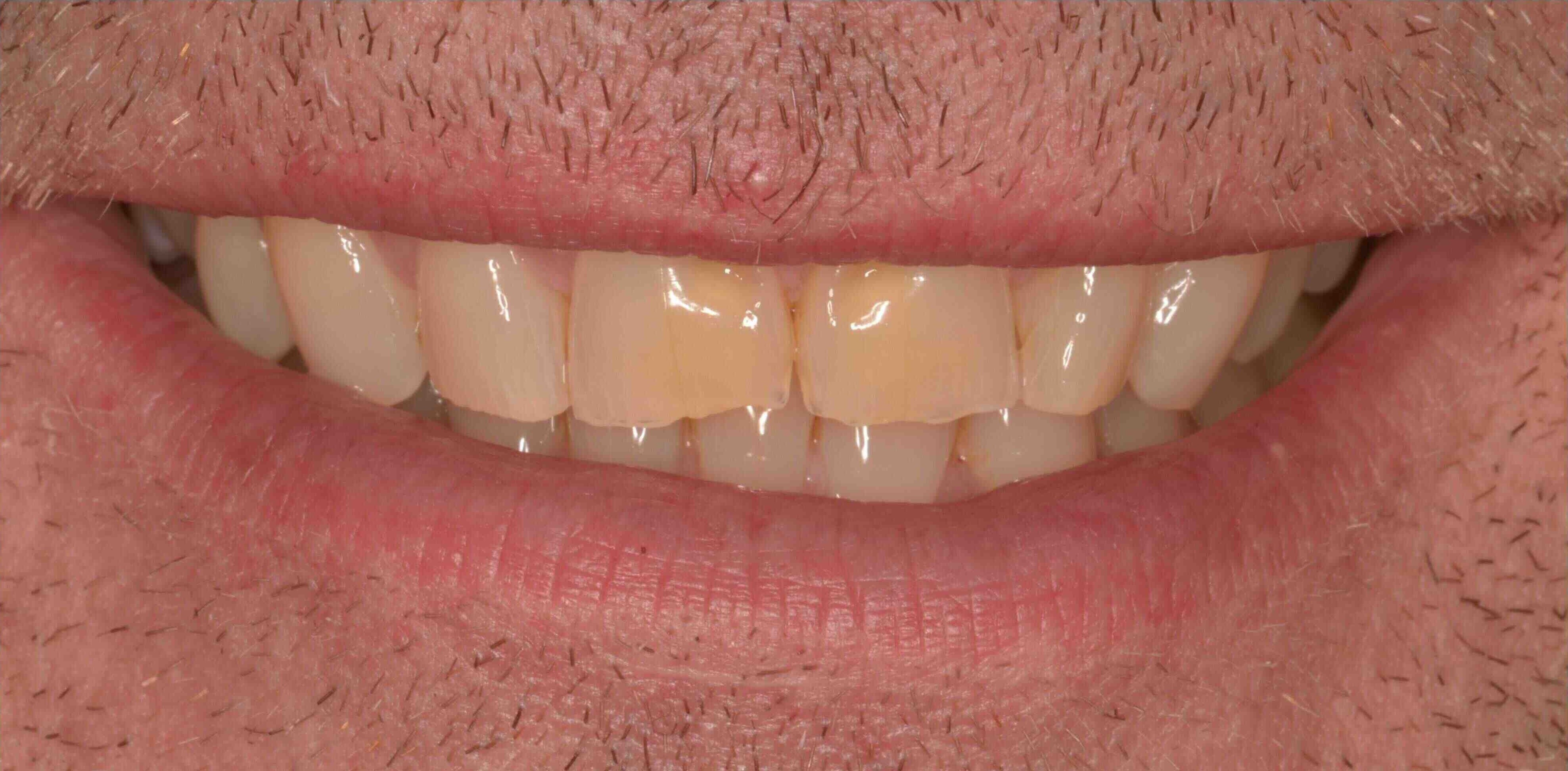 Invisalign and whitening transformation